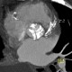 Aortic valve, calcified aortic valve: CT - Computed tomography
